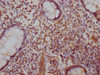 IHC image of CSB-PA892170LA01HU diluted at 1:100 and staining in paraffin-embedded human colon cancer performed on a Leica BondTM system. After dewaxing and hydration, antigen retrieval was mediated by high pressure in a citrate buffer (pH 6.0) . Section was blocked with 10% normal goat serum 30min at RT. Then primary antibody (1% BSA) was incubated at 4°C overnight. The primary is detected by a Goat anti-rabbit IgG labeled by HRP and visualized using 0.05% DAB.