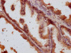 IHC image of CSB-PA847661LA01HU diluted at 1:500 and staining in paraffin-embedded human prostate tissue performed on a Leica BondTM system. After dewaxing and hydration, antigen retrieval was mediated by high pressure in a citrate buffer (pH 6.0) . Section was blocked with 10% normal goat serum 30min at RT. Then primary antibody (1% BSA) was incubated at 4°C overnight. The primary is detected by a Goat anti-rabbit IgG labeled by HRP and visualized using 0.05% DAB.