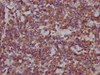 IHC image of CSB-PA889096LA01HU diluted at 1:200 and staining in paraffin-embedded human lung cancer performed on a Leica BondTM system. After dewaxing and hydration, antigen retrieval was mediated by high pressure in a citrate buffer (pH 6.0) . Section was blocked with 10% normal goat serum 30min at RT. Then primary antibody (1% BSA) was incubated at 4°C overnight. The primary is detected by a Goat anti-rabbit IgG labeled by HRP and visualized using 0.05% DAB.