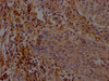 IHC image of CSB-PA892141LA01HU diluted at 1:200 and staining in paraffin-embedded human cervical cancer performed on a Leica BondTM system. After dewaxing and hydration, antigen retrieval was mediated by high pressure in a citrate buffer (pH 6.0) . Section was blocked with 10% normal goat serum 30min at RT. Then primary antibody (1% BSA) was incubated at 4°C overnight. The primary is detected by a Goat anti-rabbit polymer IgG labeled by HRP and visualized using 0.05% DAB.
