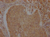 IHC image of CSB-PA002277LA01HU diluted at 1:100 and staining in paraffin-embedded human cervical cancer performed on a Leica BondTM system. After dewaxing and hydration, antigen retrieval was mediated by high pressure in a citrate buffer (pH 6.0) . Section was blocked with 10% normal goat serum 30min at RT. Then primary antibody (1% BSA) was incubated at 4°C overnight. The primary is detected by a Goat anti-rabbit polymer IgG labeled by HRP and visualized using 0.05% DAB.