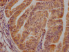 IHC image of CSB-PA005074LA01HU diluted at 1:300 and staining in paraffin-embedded human endometrial cancer performed on a Leica BondTM system. After dewaxing and hydration, antigen retrieval was mediated by high pressure in a citrate buffer (pH 6.0) . Section was blocked with 10% normal goat serum 30min at RT. Then primary antibody (1% BSA) was incubated at 4°C overnight. The primary is detected by a Goat anti-rabbit polymer IgG labeled by HRP and visualized using 0.05% DAB.