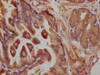 IHC image of CSB-PA008452LA01HU diluted at 1:200 and staining in paraffin-embedded human prostate tissue performed on a Leica BondTM system. After dewaxing and hydration, antigen retrieval was mediated by high pressure in a citrate buffer (pH 6.0) . Section was blocked with 10% normal goat serum 30min at RT. Then primary antibody (1% BSA) was incubated at 4°C overnight. The primary is detected by a Goat anti-rabbit polymer IgG labeled by HRP and visualized using 0.05% DAB.