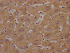 IHC image of CSB-PA836757OA01HU diluted at 1:200 and staining in paraffin-embedded human liver cancer performed on a Leica BondTM system. After dewaxing and hydration, antigen retrieval was mediated by high pressure in a citrate buffer (pH 6.0) . Section was blocked with 10% normal goat serum 30min at RT. Then primary antibody (1% BSA) was incubated at 4°C overnight. The primary is detected by a Goat anti-rabbit polymer IgG labeled by HRP and visualized using 0.05% DAB.