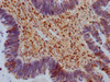 IHC image of CSB-PA020691LA01HU diluted at 1:100 and staining in paraffin-embedded human ovarian cancer performed on a Leica BondTM system. After dewaxing and hydration, antigen retrieval was mediated by high pressure in a citrate buffer (pH 6.0) . Section was blocked with 10% normal goat serum 30min at RT. Then primary antibody (1% BSA) was incubated at 4°C overnight. The primary is detected by a Goat anti-rabbit IgG labeled by HRP and visualized using 0.05% DAB.