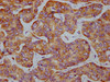 IHC image of CSB-RA007523A51phHU diluted at 1:100 and staining in paraffin-embedded human liver cancer performed on a Leica BondTM system. After dewaxing and hydration, antigen retrieval was mediated by high pressure in a citrate buffer (pH 6.0). Section was blocked with 10% normal goat serum 30min at RT. Then primary antibody (1% BSA) was incubated at 4°C overnight. The primary is detected by a biotinylated secondary antibody and visualized using an HRP conjugated SP system.