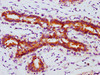 IHC image of CSB-RA008836A253phHU diluted at 1:100 and staining in paraffin-embedded human breast cancer performed on a Leica BondTM system. After dewaxing and hydration, antigen retrieval was mediated by high pressure in a citrate buffer (pH 6.0). Section was blocked with 10% normal goat serum 30min at RT. Then primary antibody (1% BSA) was incubated at 4°C overnight. The primary is detected by a biotinylated secondary antibody and visualized using an HRP conjugated SP system.