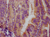 IHC image of CSB-RA008836A253phHU diluted at 1:100 and staining in paraffin-embedded human endometrial cancer performed on a Leica BondTM system. After dewaxing and hydration, antigen retrieval was mediated by high pressure in a citrate buffer (pH 6.0). Section was blocked with 10% normal goat serum 30min at RT. Then primary antibody (1% BSA) was incubated at 4°C overnight. The primary is detected by a biotinylated secondary antibody and visualized using an HRP conjugated SP system.