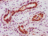 IHC image of CSB-RA022814A694phHU diluted at 1:100 and staining in paraffin-embedded human breast cancer performed on a Leica BondTM system. After dewaxing and hydration, antigen retrieval was mediated by high pressure in a citrate buffer (pH 6.0). Section was blocked with 10% normal goat serum 30min at RT. Then primary antibody (1% BSA) was incubated at 4°C overnight. The primary is detected by a biotinylated secondary antibody and visualized using an HRP conjugated SP system.