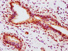 IHC image of CSB-RA007830A118phHU diluted at 1:100 and staining in paraffin-embedded human breast cancer performed on a Leica BondTM system. After dewaxing and hydration, antigen retrieval was mediated by high pressure in a citrate buffer (pH 6.0). Section was blocked with 10% normal goat serum 30min at RT. Then primary antibody (1% BSA) was incubated at 4°C overnight. The primary is detected by a biotinylated secondary antibody and visualized using an HRP conjugated SP system.