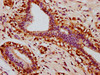 IHC image of CSB-RA022812A727phHU diluted at 1:100 and staining in paraffin-embedded human breast cancer performed on a Leica BondTM system. After dewaxing and hydration, antigen retrieval was mediated by high pressure in a citrate buffer (pH 6.0). Section was blocked with 10% normal goat serum 30min at RT. Then primary antibody (1% BSA) was incubated at 4°C overnight. The primary is detected by a biotinylated secondary antibody and visualized using an HRP conjugated SP system.