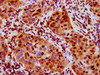 IHC image of CSB-RA020468A376phHU diluted at 1:100 and staining in paraffin-embedded human bladder cancer performed on a Leica BondTM system. After dewaxing and hydration, antigen retrieval was mediated by high pressure in a citrate buffer (pH 6.0). Section was blocked with 10% normal goat serum 30min at RT. Then primary antibody (1% BSA) was incubated at 4°C overnight. The primary is detected by a biotinylated secondary antibody and visualized using an HRP conjugated SP system.