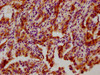 IHC image of CSB-RA010833A82phHU diluted at 1:100 and staining in paraffin-embedded human lung cancer performed on a Leica BondTM system. After dewaxing and hydration, antigen retrieval was mediated by high pressure in a citrate buffer (pH 6.0). Section was blocked with 10% normal goat serum 30min at RT. Then primary antibody (1% BSA) was incubated at 4°C overnight. The primary is detected by a biotinylated secondary antibody and visualized using an HRP conjugated SP system.