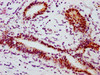 IHC image of CSB-RA022810A727phHU diluted at 1:100 and staining in paraffin-embedded human breast cancer performed on a Leica BondTM system. After dewaxing and hydration, antigen retrieval was mediated by high pressure in a citrate buffer (pH 6.0). Section was blocked with 10% normal goat serum 30min at RT. Then primary antibody (1% BSA) was incubated at 4°C overnight. The primary is detected by a biotinylated secondary antibody and visualized using an HRP conjugated SP system.