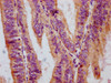 IHC image of CSB-RA019284A259phHU diluted at 1:100 and staining in paraffin-embedded human endometrial cancer performed on a Leica BondTM system. After dewaxing and hydration, antigen retrieval was mediated by high pressure in a citrate buffer (pH 6.0). Section was blocked with 10% normal goat serum 30min at RT. Then primary antibody (1% BSA) was incubated at 4°C overnight. The primary is detected by a biotinylated secondary antibody and visualized using an HRP conjugated SP system.