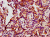 IHC image of CSB-RA010833A78phHU diluted at 1:100 and staining in paraffin-embedded human lung cancer performed on a Leica BondTM system. After dewaxing and hydration, antigen retrieval was mediated by high pressure in a citrate buffer (pH 6.0). Section was blocked with 10% normal goat serum 30min at RT. Then primary antibody (1% BSA) was incubated at 4°C overnight. The primary is detected by a biotinylated secondary antibody and visualized using an HRP conjugated SP system.