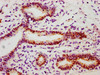 IHC image of CSB-RA010833A78phHU diluted at 1:100 and staining in paraffin-embedded human breast cancer performed on a Leica BondTM system. After dewaxing and hydration, antigen retrieval was mediated by high pressure in a citrate buffer (pH 6.0). Section was blocked with 10% normal goat serum 30min at RT. Then primary antibody (1% BSA) was incubated at 4°C overnight. The primary is detected by a biotinylated secondary antibody and visualized using an HRP conjugated SP system.