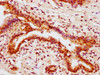 IHC image of CSB-RA001553A473phHU diluted at 1:100 and staining in paraffin-embedded human breast cancer performed on a Leica BondTM system. After dewaxing and hydration, antigen retrieval was mediated by high pressure in a citrate buffer (pH 6.0). Section was blocked with 10% normal goat serum 30min at RT. Then primary antibody (1% BSA) was incubated at 4°C overnight. The primary is detected by a biotinylated secondary antibody and visualized using an HRP conjugated SP system.