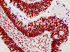 IHC image of CSB-RA018327A02phHU diluted at 1:100 and staining in paraffin-embedded human ovarian cancer performed on a Leica BondTM system. After dewaxing and hydration, antigen retrieval was mediated by high pressure in a citrate buffer (pH 6.0). Section was blocked with 10% normal goat serum 30min at RT. Then primary antibody (1% BSA) was incubated at 4°C overnight. The primary is detected by a biotinylated secondary antibody and visualized using an HRP conjugated SP system.