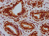 IHC image of CSB-RA019386A780phHU diluted at 1:100 and staining in paraffin-embedded human breast cancer performed on a Leica BondTM system. After dewaxing and hydration, antigen retrieval was mediated by high pressure in a citrate buffer (pH 6.0). Section was blocked with 10% normal goat serum 30min at RT. Then primary antibody (1% BSA) was incubated at 4°C overnight. The primary is detected by a biotinylated secondary antibody and visualized using an HRP conjugated SP system.