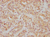 IHC image of CSB-RA010242A0HU diluted at 1:112.5 and staining in paraffin-embedded human liver cancer performed on a Leica BondTM system. After dewaxing and hydration, antigen retrieval was mediated by high pressure in a citrate buffer (pH 6.0). Section was blocked with 10% normal goat serum 30min at RT. Then primary antibody (1% BSA) was incubated at 4°C overnight. The primary is detected by a biotinylated secondary antibody and visualized using an HRP conjugated SP system.