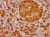 IHC image of CSB-RA887971A0HU diluted at 1:210 and staining in paraffin-embedded human pancreatic cancer performed on a Leica BondTM system. After dewaxing and hydration, antigen retrieval was mediated by high pressure in a citrate buffer (pH 6.0). Section was blocked with 10% normal goat serum 30min at RT. Then primary antibody (1% BSA) was incubated at 4°C overnight. The primary is detected by a biotinylated secondary antibody and visualized using an HRP conjugated SP system.