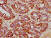 IHC image of CSB-RA835678A0HU diluted at 1:71.6666666666667 and staining in paraffin-embedded human breast cancer performed on a Leica BondTM system. After dewaxing and hydration, antigen retrieval was mediated by high pressure in a citrate buffer (pH 6.0). Section was blocked with 10% normal goat serum 30min at RT. Then primary antibody (1% BSA) was incubated at 4°C overnight. The primary is detected by a biotinylated secondary antibody and visualized using an HRP conjugated SP system.