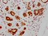 IHC image of CSB-RA618770A0HU diluted at 1:205 and staining in paraffin-embedded human breast cancer performed on a Leica BondTM system. After dewaxing and hydration, antigen retrieval was mediated by high pressure in a citrate buffer (pH 6.0). Section was blocked with 10% normal goat serum 30min at RT. Then primary antibody (1% BSA) was incubated at 4°C overnight. The primary is detected by a biotinylated secondary antibody and visualized using an HRP conjugated SP system.