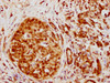 IHC image of CSB-RA010611A0HU diluted at 1:130.5 and staining in paraffin-embedded human pancreatic cancer performed on a Leica BondTM system. After dewaxing and hydration, antigen retrieval was mediated by high pressure in a citrate buffer (pH 6.0). Section was blocked with 10% normal goat serum 30min at RT. Then primary antibody (1% BSA) was incubated at 4°C overnight. The primary is detected by a biotinylated secondary antibody and visualized using an HRP conjugated SP system.