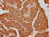 IHC image of CSB-RA010611A0HU diluted at 1:130.5 and staining in paraffin-embedded human cervical cancer performed on a Leica BondTM system. After dewaxing and hydration, antigen retrieval was mediated by high pressure in a citrate buffer (pH 6.0). Section was blocked with 10% normal goat serum 30min at RT. Then primary antibody (1% BSA) was incubated at 4°C overnight. The primary is detected by a biotinylated secondary antibody and visualized using an HRP conjugated SP system.