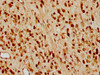 IHC image of CSB-RA005087A0HU diluted at 1:97.5 and staining in paraffin-embedded human glioma cancer performed on a Leica BondTM system. After dewaxing and hydration, antigen retrieval was mediated by high pressure in a citrate buffer (pH 6.0). Section was blocked with 10% normal goat serum 30min at RT. Then primary antibody (1% BSA) was incubated at 4°C overnight. The primary is detected by a biotinylated secondary antibody and visualized using an HRP conjugated SP system.