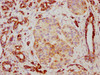 IHC image of CSB-RA025168A0HU diluted at 1:117 and staining in paraffin-embedded human pancreatic cancer performed on a Leica BondTM system. After dewaxing and hydration, antigen retrieval was mediated by high pressure in a citrate buffer (pH 6.0). Section was blocked with 10% normal goat serum 30min at RT. Then primary antibody (1% BSA) was incubated at 4°C overnight. The primary is detected by a biotinylated secondary antibody and visualized using an HRP conjugated SP system.