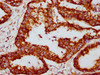 IHC image of CSB-RA025168A0HU diluted at 1:117 and staining in paraffin-embedded human colon cancer performed on a Leica BondTM system. After dewaxing and hydration, antigen retrieval was mediated by high pressure in a citrate buffer (pH 6.0). Section was blocked with 10% normal goat serum 30min at RT. Then primary antibody (1% BSA) was incubated at 4°C overnight. The primary is detected by a biotinylated secondary antibody and visualized using an HRP conjugated SP system.