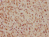 IHC image of CSB-RA004996A0HU diluted at 1:165 and staining in paraffin-embedded human glioma cancer performed on a Leica BondTM system. After dewaxing and hydration, antigen retrieval was mediated by high pressure in a citrate buffer (pH 6.0). Section was blocked with 10% normal goat serum 30min at RT. Then primary antibody (1% BSA) was incubated at 4°C overnight. The primary is detected by a biotinylated secondary antibody and visualized using an HRP conjugated SP system.