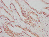 IHC image of CSB-RA002121A0HU diluted at 1:183 and staining in paraffin-embedded human prostate cancer performed on a Leica BondTM system. After dewaxing and hydration, antigen retrieval was mediated by high pressure in a citrate buffer (pH 6.0). Section was blocked with 10% normal goat serum 30min at RT. Then primary antibody (1% BSA) was incubated at 4°C overnight. The primary is detected by a biotinylated secondary antibody and visualized using an HRP conjugated SP system.