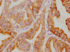 IHC image of CSB-RA015761A0HU diluted at 1:79.75 and staining in paraffin-embedded human endometrial cancer performed on a Leica BondTM system. After dewaxing and hydration, antigen retrieval was mediated by high pressure in a citrate buffer (pH 6.0). Section was blocked with 10% normal goat serum 30min at RT. Then primary antibody (1% BSA) was incubated at 4°C overnight. The primary is detected by a biotinylated secondary antibody and visualized using an HRP conjugated SP system.
