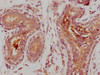 IHC image of CSB-RA014679A0HU diluted at 1:235 and staining in paraffin-embedded human breast cancer performed on a Leica BondTM system. After dewaxing and hydration, antigen retrieval was mediated by high pressure in a citrate buffer (pH 6.0). Section was blocked with 10% normal goat serum 30min at RT. Then primary antibody (1% BSA) was incubated at 4°C overnight. The primary is detected by a biotinylated secondary antibody and visualized using an HRP conjugated SP system.