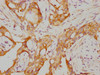 IHC image of CSB-RA019338A0HU diluted at 1:155 and staining in paraffin-embedded human breast cancer performed on a Leica BondTM system. After dewaxing and hydration, antigen retrieval was mediated by high pressure in a citrate buffer (pH 6.0). Section was blocked with 10% normal goat serum 30min at RT. Then primary antibody (1% BSA) was incubated at 4°C overnight. The primary is detected by a biotinylated secondary antibody and visualized using an HRP conjugated SP system.