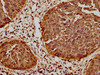 IHC image of CSB-RA010833A0HU diluted at 1:61.9 and staining in paraffin-embedded human cervical cancer performed on a Leica BondTM system. After dewaxing and hydration, antigen retrieval was mediated by high pressure in a citrate buffer (pH 6.0). Section was blocked with 10% normal goat serum 30min at RT. Then primary antibody (1% BSA) was incubated at 4°C overnight. The primary is detected by a biotinylated secondary antibody and visualized using an HRP conjugated SP system.