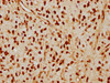 IHC image of CSB-RA013003A0HU diluted at 1:115 and staining in paraffin-embedded human glioma cancer performed on a Leica BondTM system. After dewaxing and hydration, antigen retrieval was mediated by high pressure in a citrate buffer (pH 6.0). Section was blocked with 10% normal goat serum 30min at RT. Then primary antibody (1% BSA) was incubated at 4°C overnight. The primary is detected by a biotinylated secondary antibody and visualized using an HRP conjugated SP system.