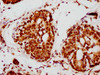 IHC image of CSB-RA013003A0HU diluted at 1:115 and staining in paraffin-embedded human breast cancer performed on a Leica BondTM system. After dewaxing and hydration, antigen retrieval was mediated by high pressure in a citrate buffer (pH 6.0). Section was blocked with 10% normal goat serum 30min at RT. Then primary antibody (1% BSA) was incubated at 4°C overnight. The primary is detected by a biotinylated secondary antibody and visualized using an HRP conjugated SP system.
