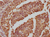 IHC image of CSB-RA008790A0HU diluted at 1:81 and staining in paraffin-embedded human cervical cancer performed on a Leica BondTM system. After dewaxing and hydration, antigen retrieval was mediated by high pressure in a citrate buffer (pH 6.0). Section was blocked with 10% normal goat serum 30min at RT. Then primary antibody (1% BSA) was incubated at 4°C overnight. The primary is detected by a biotinylated secondary antibody and visualized using an HRP conjugated SP system.