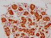 IHC image of CSB-RA002531A0HU diluted at 1:73.75 and staining in paraffin-embedded human breast cancer performed on a Leica BondTM system. After dewaxing and hydration, antigen retrieval was mediated by high pressure in a citrate buffer (pH 6.0). Section was blocked with 10% normal goat serum 30min at RT. Then primary antibody (1% BSA) was incubated at 4°C overnight. The primary is detected by a biotinylated secondary antibody and visualized using an HRP conjugated SP system. IHC image of CSB-RA002531A0HU diluted at 1:73.75 and staining in paraffin-embedded human breast cancer performed on a Leica BondTM system. After dewaxing and hydration, antigen retrieval was mediated by high pressure in a citrate buffer (pH 6.0). Section was blocked with 10% normal goat serum 30min at RT. Then primary antibody (1% BSA) was incubated at 4°C overnight. The primary is detected by a biotinylated secondary antibody and visualized using an HRP conjugated SP system.