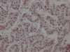 IHC image of CSB-RA152430A0HU diluted at 1:100 and staining in paraffin-embedded human breast cancer performed on a Leica BondTM system. After dewaxing and hydration, antigen retrieval was mediated by high pressure in a citrate buffer (pH 6.0). Section was blocked with 10% normal goat serum 30min at RT. Then primary antibody (1% BSA) was incubated at 4°C overnight. The primary is detected by a Goat anti-rabbit IgG polymer labeled by HRP and visualized using 0.05% DAB.