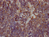 IHC image of CSB-RA297401A0HU diluted at 1:100 and staining in paraffin-embedded human lung cancer performed on a Leica BondTM system. After dewaxing and hydration, antigen retrieval was mediated by high pressure in a citrate buffer (pH 6.0). Section was blocked with 10% normal goat serum 30min at RT. Then primary antibody (1% BSA) was incubated at 4°C overnight. The primary is detected by a Goat anti-rabbit IgG polymer labeled by HRP and visualized using 0.05% DAB.