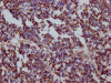 IHC image of CSB-RA953395A0HU diluted at 1:100 and staining in paraffin-embedded human liver cancer performed on a Leica BondTM system. After dewaxing and hydration, antigen retrieval was mediated by high pressure in a citrate buffer (pH 6.0). Section was blocked with 10% normal goat serum 30min at RT. Then primary antibody (1% BSA) was incubated at 4°C overnight. The primary is detected by a Goat anti-rabbit IgG polymer labeled by HRP and visualized using 0.05% DAB.