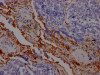 IHC image of CSB-RA162789A0HU diluted at 1:100 and staining in paraffin-embedded human lung cancer performed on a Leica BondTM system. After dewaxing and hydration, antigen retrieval was mediated by high pressure in a citrate buffer (pH 6.0). Section was blocked with 10% normal goat serum 30min at RT. Then primary antibody (1% BSA) was incubated at 4°C overnight. The primary is detected by a Goat anti-rabbit IgG polymer labeled by HRP and visualized using 0.05% DAB.