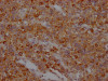 IHC image of CSB-RA246354A0HU diluted at 1:100 and staining in paraffin-embedded human glioma cancer performed on a Leica BondTM system. After dewaxing and hydration, antigen retrieval was mediated by high pressure in a citrate buffer (pH 6.0). Section was blocked with 10% normal goat serum 30min at RT. Then primary antibody (1% BSA) was incubated at 4°C overnight. The primary is detected by a Goat anti-rabbit IgG polymer labeled by HRP and visualized using 0.05% DAB.