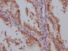 IHC image of CSB-RA906662A0HU diluted at 1:100 and staining in paraffin-embedded human endometrial cancer performed on a Leica BondTM system. After dewaxing and hydration, antigen retrieval was mediated by high pressure in a citrate buffer (pH 6.0). Section was blocked with 10% normal goat serum 30min at RT. Then primary antibody (1% BSA) was incubated at 4°C overnight. The primary is detected by a Goat anti-rabbit IgG polymer labeled by HRP and visualized using 0.05% DAB.