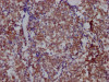 IHC image of CSB-RA906662A0HU diluted at 1:100 and staining in paraffin-embedded human lung cancer performed on a Leica BondTM system. After dewaxing and hydration, antigen retrieval was mediated by high pressure in a citrate buffer (pH 6.0). Section was blocked with 10% normal goat serum 30min at RT. Then primary antibody (1% BSA) was incubated at 4°C overnight. The primary is detected by a Goat anti-rabbit IgG polymer labeled by HRP and visualized using 0.05% DAB.